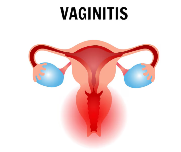 أنواع التهابات المهبل